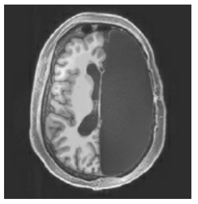 Diagram of Matthew's brain post-surgery